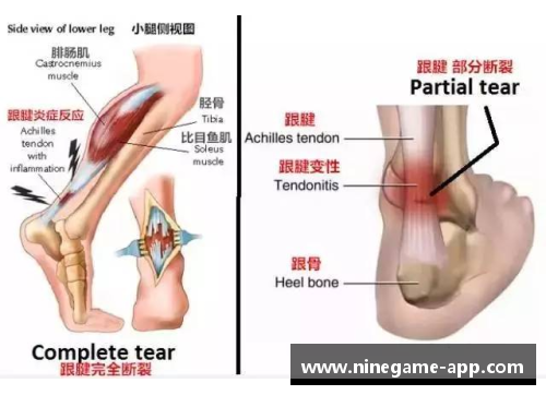 运动员跟腱撕裂：原因、治疗与康复